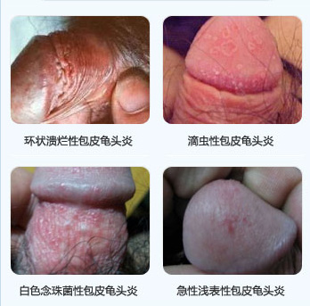 龟头炎