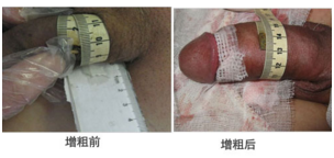 增粗