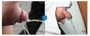 尿道口下裂